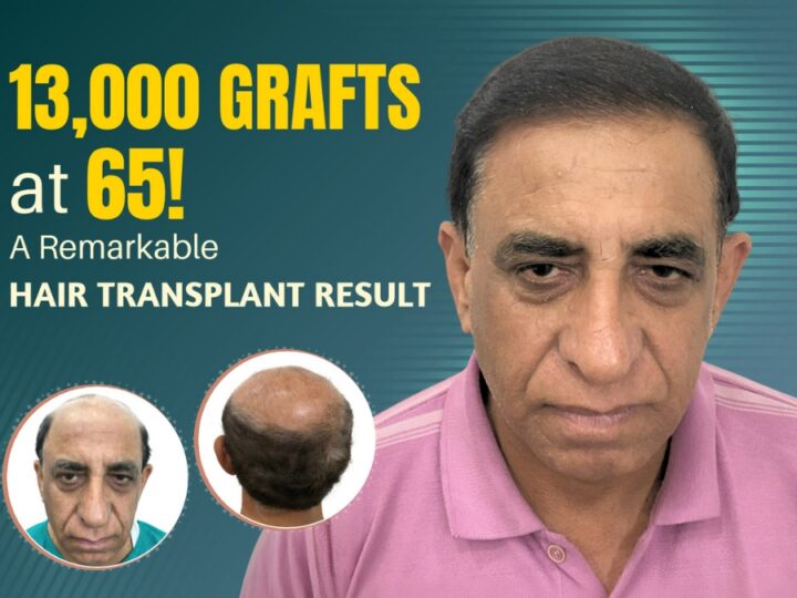 65-Year-Old, 13,000 Grafts Implanted in a Single Session: An Insight into a Remarkable Hair Transplant Procedure